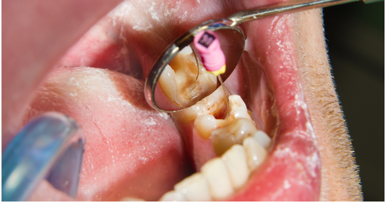 22 7 showing the concept of Demystifying Root Canal Treatment: What To Expect During The Procedure