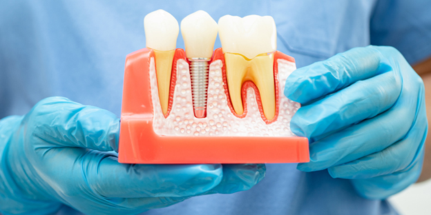 33 2 showing the concept of Debunking Myths: How Painful Is A Root Canal Procedure Really?