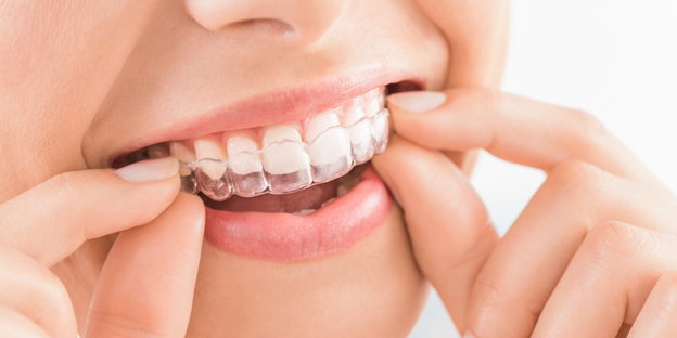 44 1 showing the concept of Enhancing Your Smile: The Role Of Veneers, Crowns, And Invisalign