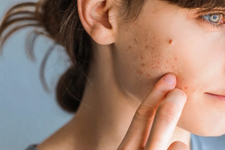 Woman with red cheeks- diathesis or allergy symptoms