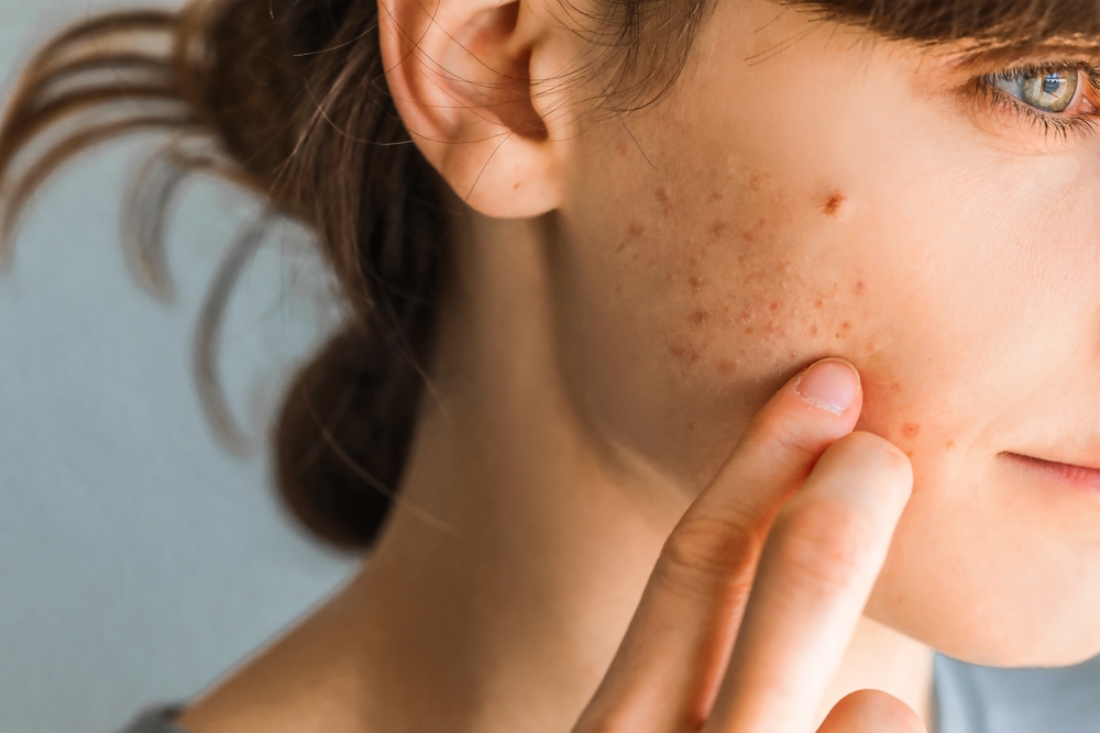 Woman with red cheeks- diathesis or allergy symptoms