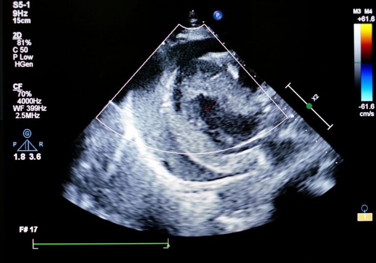 How an Echocardiogram Helps Detect Heart Problems