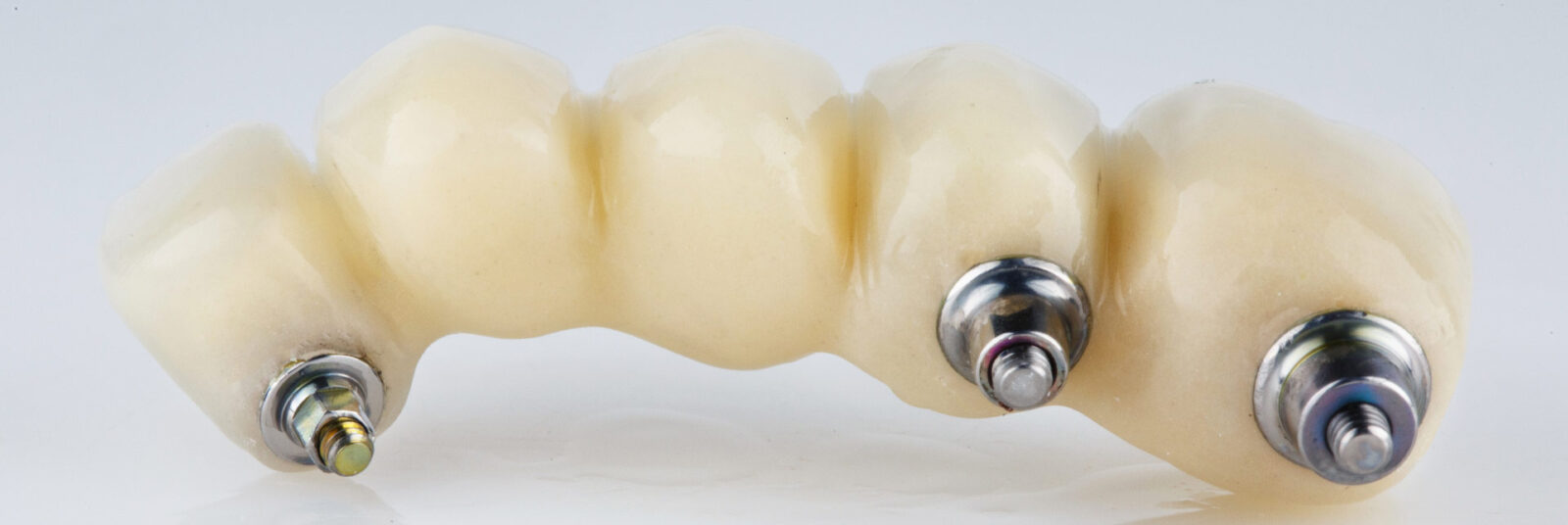 Beautiful composition of a dental bridge for five teeth with a metal beam