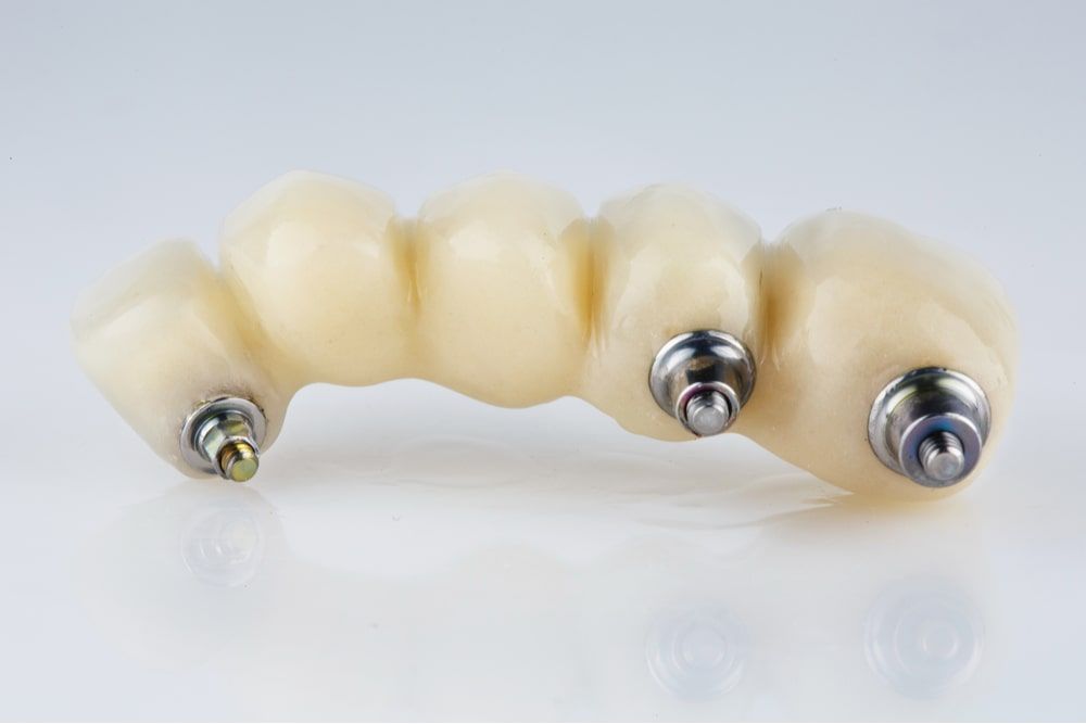 Beautiful composition of a dental bridge for five teeth with a metal beam