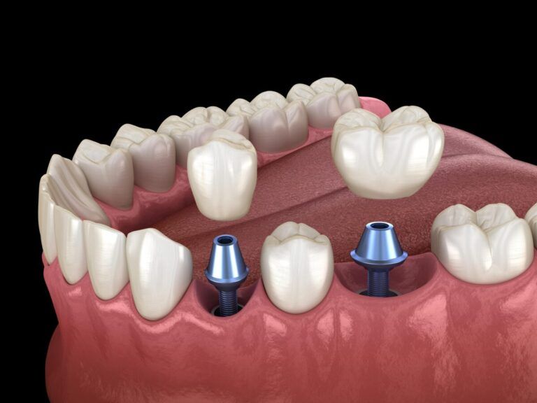 Different Types of Dental Abutments and Their Uses Savannah, GA and