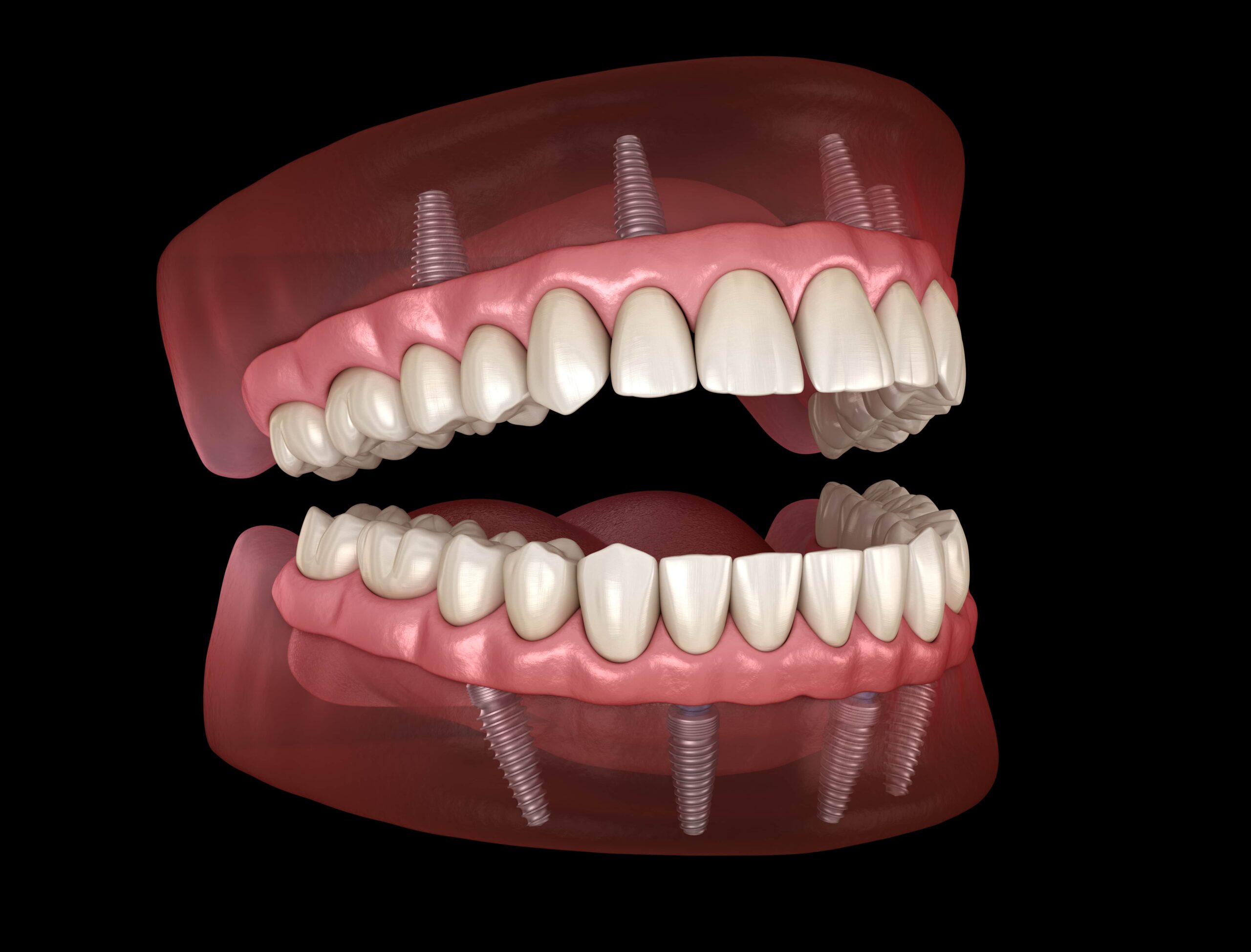 all on four dental implants