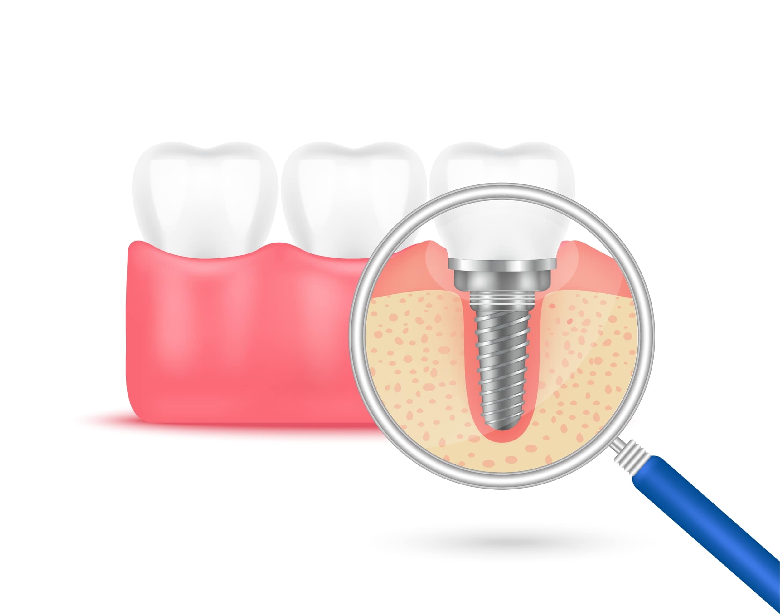 magnifying glass over dental implan