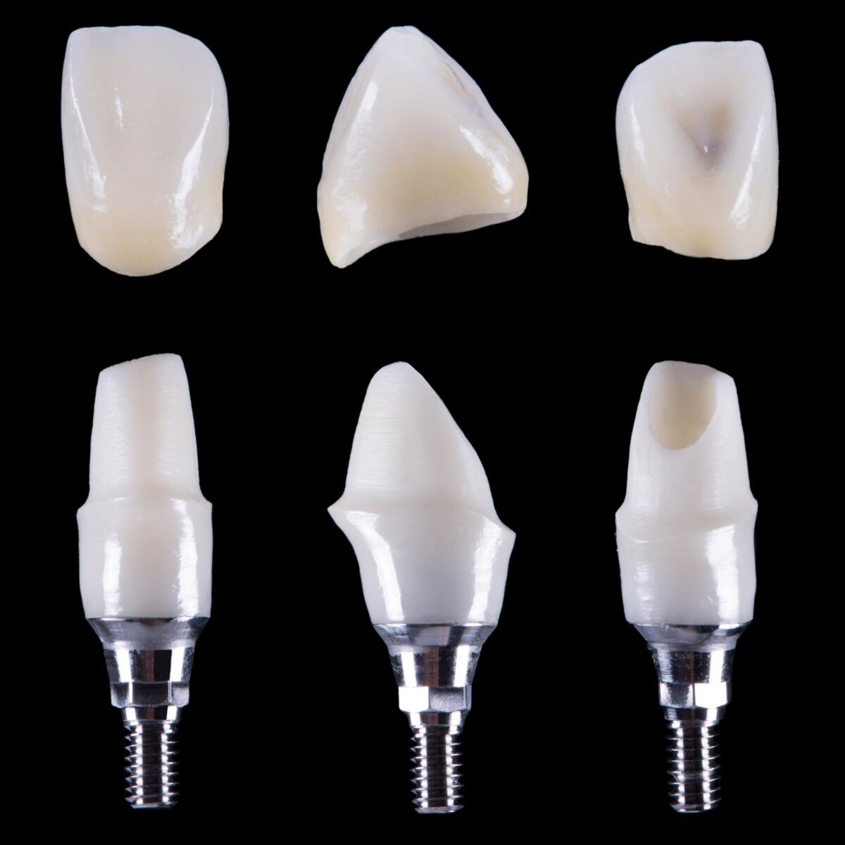 custom dental implant abutments