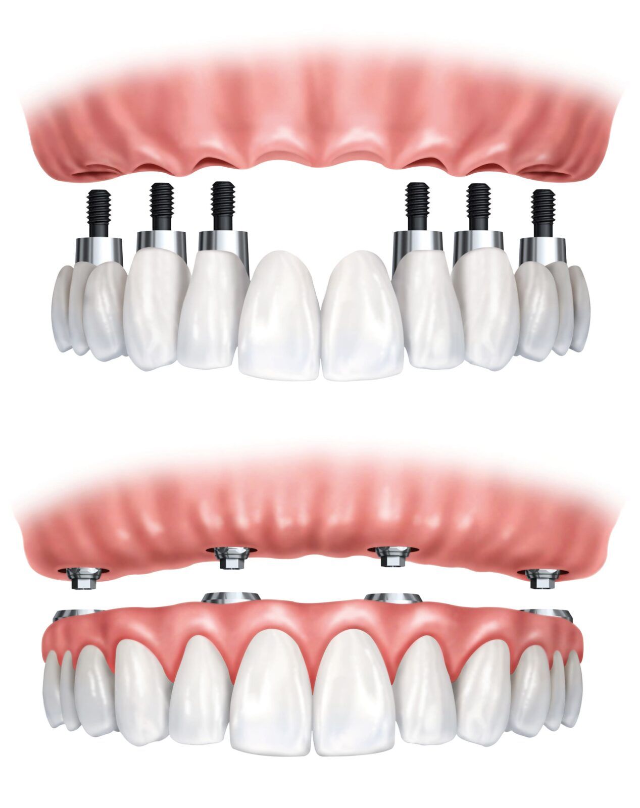 different variations of all-on-four implants