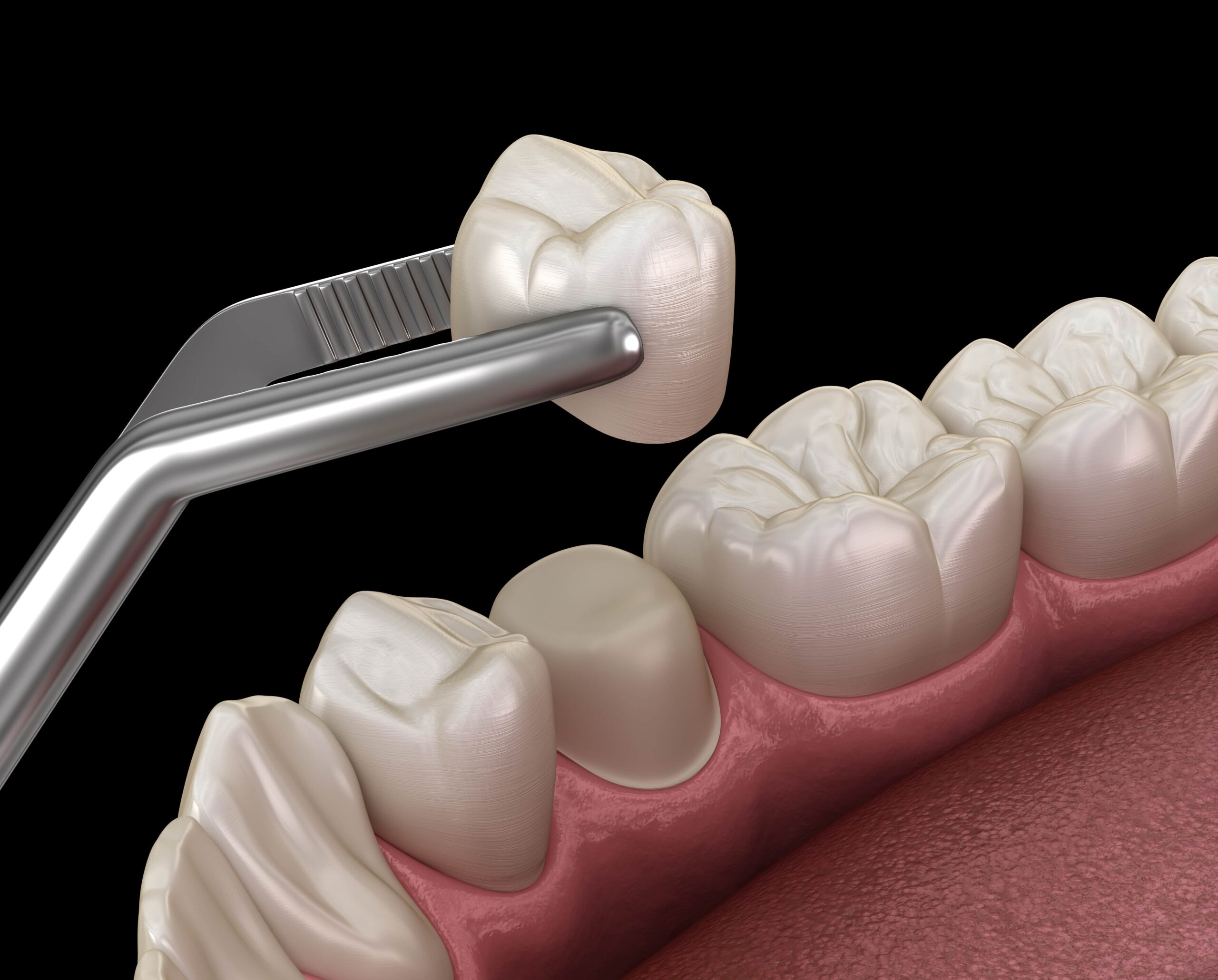 dental crown being placed on tooth