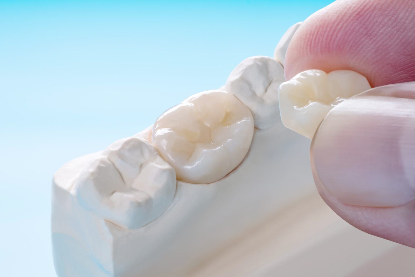 posterior tooth restoration