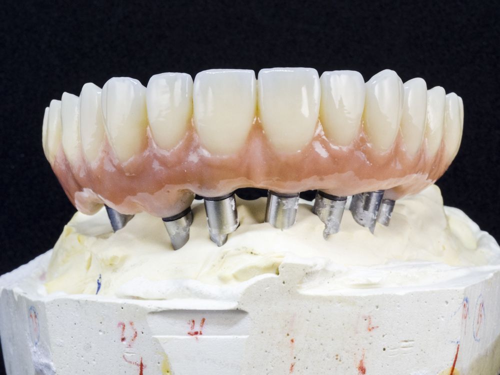 Implant-Supported Full-Arch Restorations