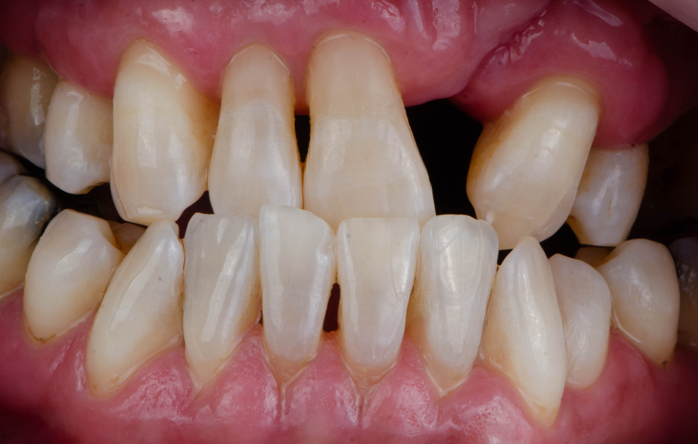 Custom-Made Dentures for Patients with Cleft Palate