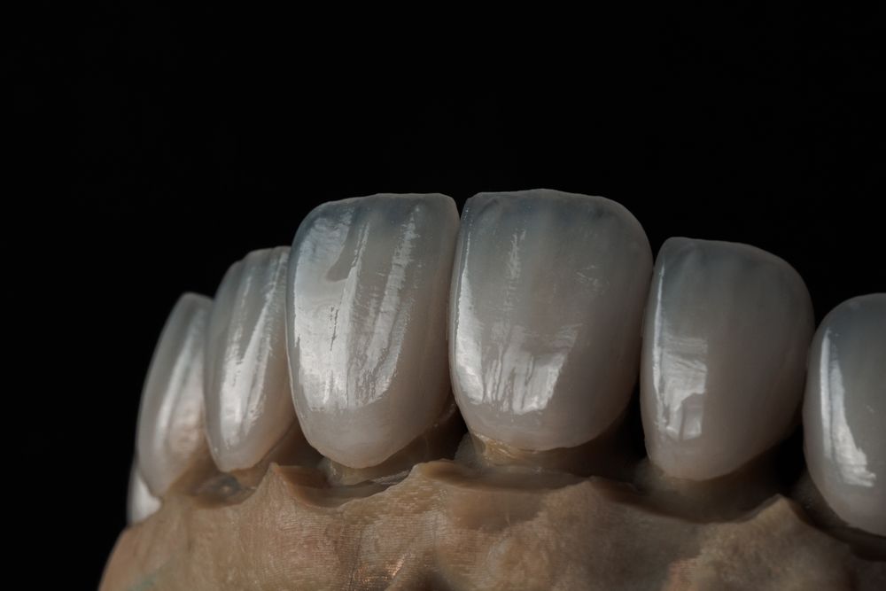 Pre-Shaded Zirconia Restorations in Aesthetic Dentistry: Advantages