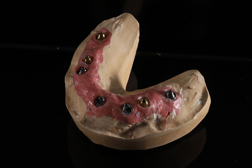 Implant Analogues: Understanding Their Uses in Fabricating Restorations