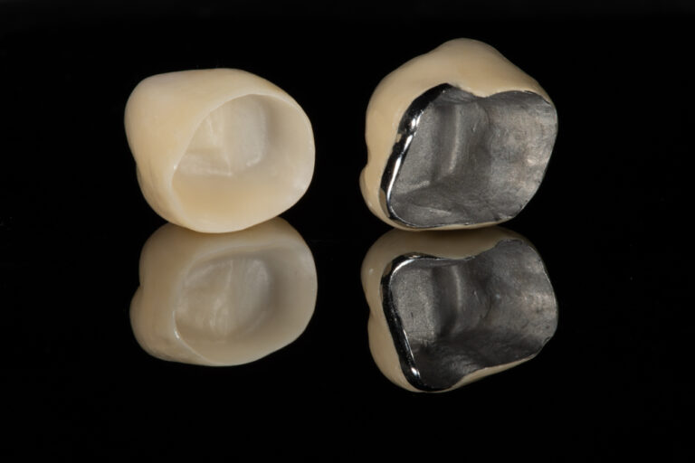 Advantages of Metal-Ceramic Restorations