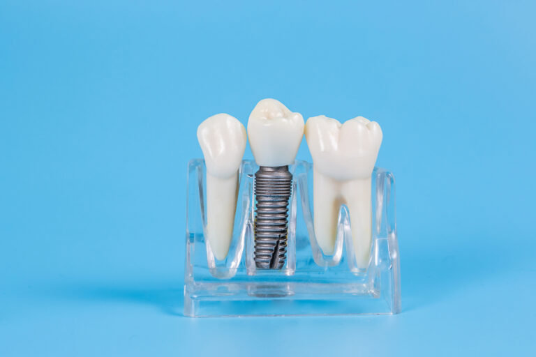 Importance of Using High-Quality Polishing Materials in Dental Restorations