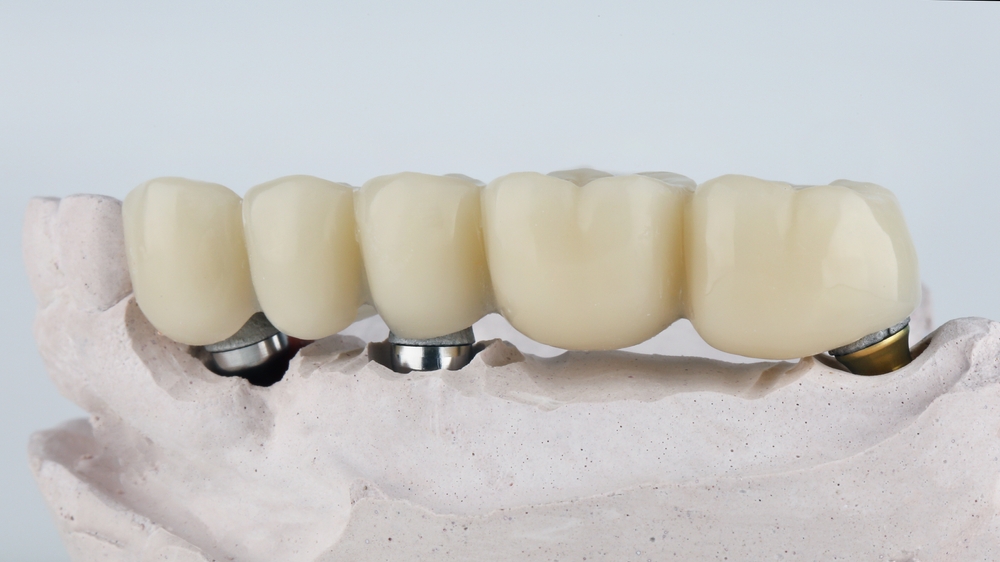 Different Types of Dental Bridges and Their Indications You're