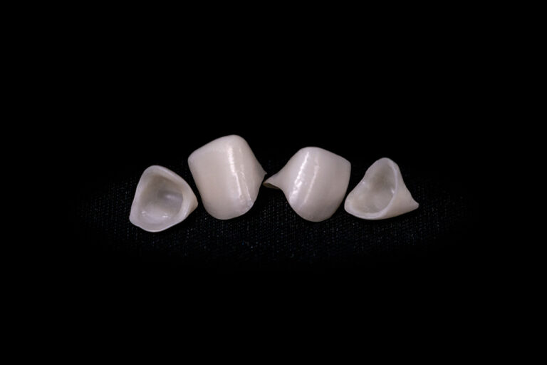 Zirconia vs. Porcelain-Fused-to-Metal (PFM): Which One is Best for Patients