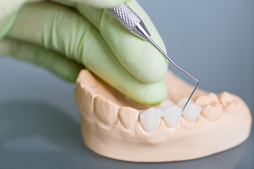 Understanding the Different Types of Fixed Restorations: Crowns, Bridges & Inlays