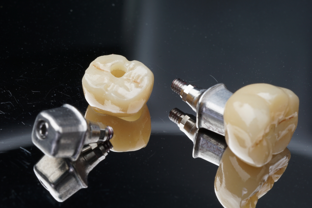 Posterior,Implant,Crown,With,Custom,Abutment