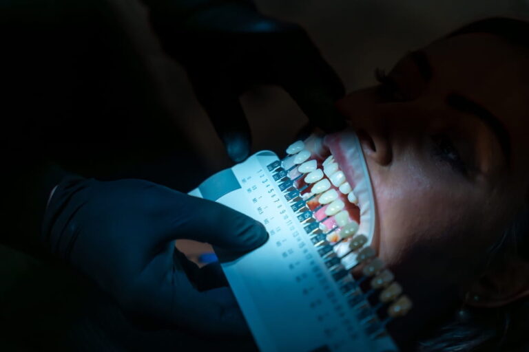 Dentist wearing black gloves comparing patient's teeth shade with samples for whitening treatment in a dental clinic