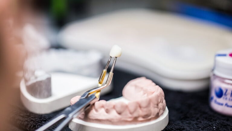 A dental technician carefully holds a crafted dental crown using tweezers over a model of teeth in a professional laboratory