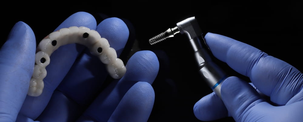 Full-arch dental prosthesis supported by 4 implants in edentulous jaws during dental implant surgery.