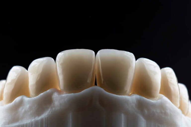 beautiful smile by zircon crowns