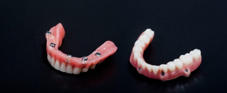 complete lower dental prosthesis process on implants photograph taken in a photographic studio