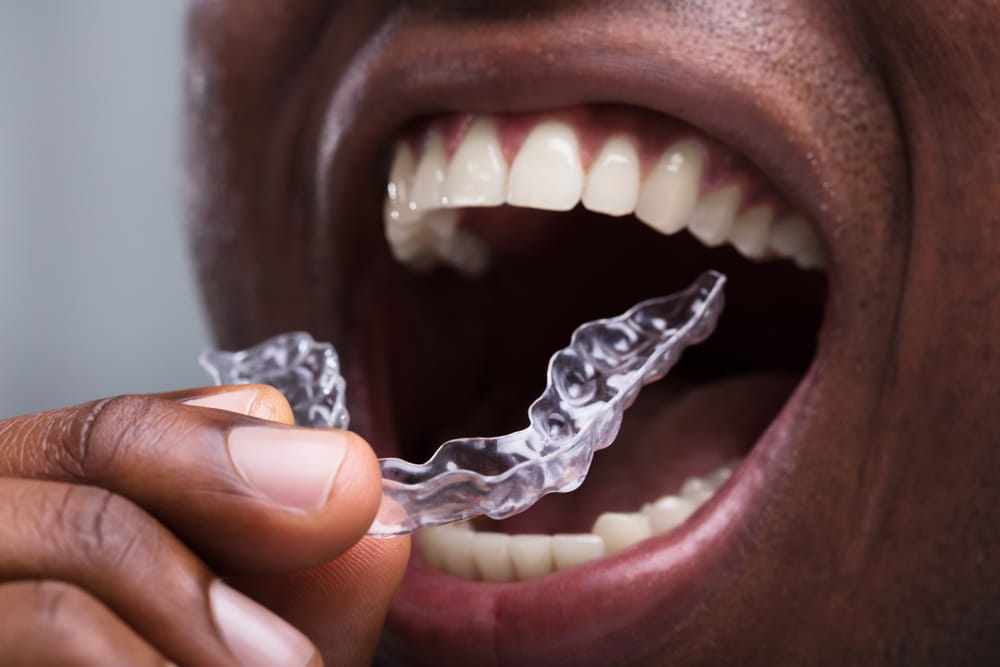 Close-up Of A Man Adjusting Transparent Aligners In His White Teeth