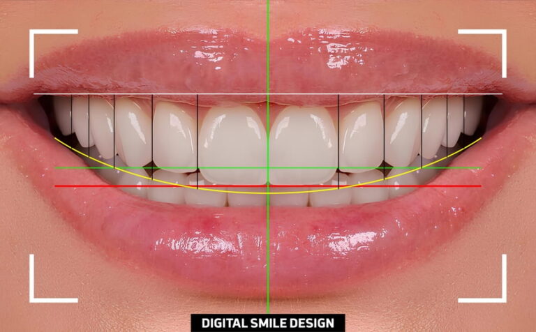 Computer-aided design for tooth alignment and smile design treatment in cosmetic dentistry. Smile makeover, dental before and after.