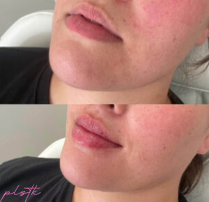 Lip Filler B&A