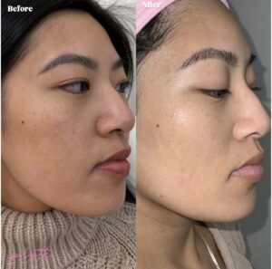 Before and After