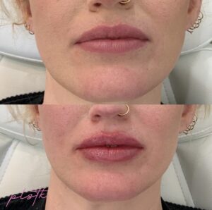woman wrinkles face after treatments