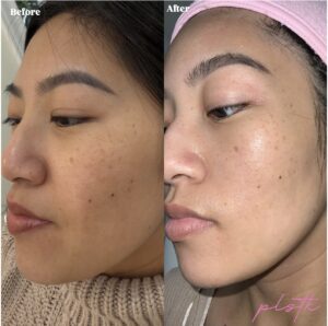 Before and After