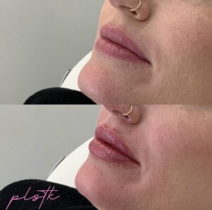 woman face wrinkles after treatment
