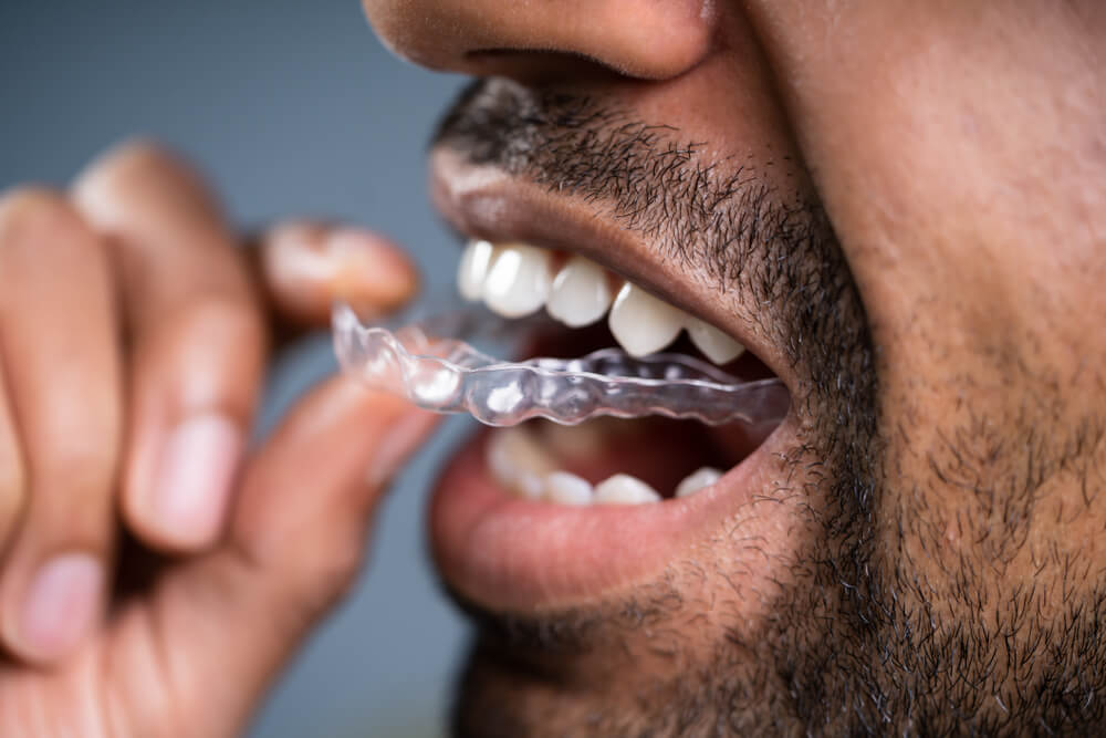 Man's Hand Putting Transparent Aligner In Teeth