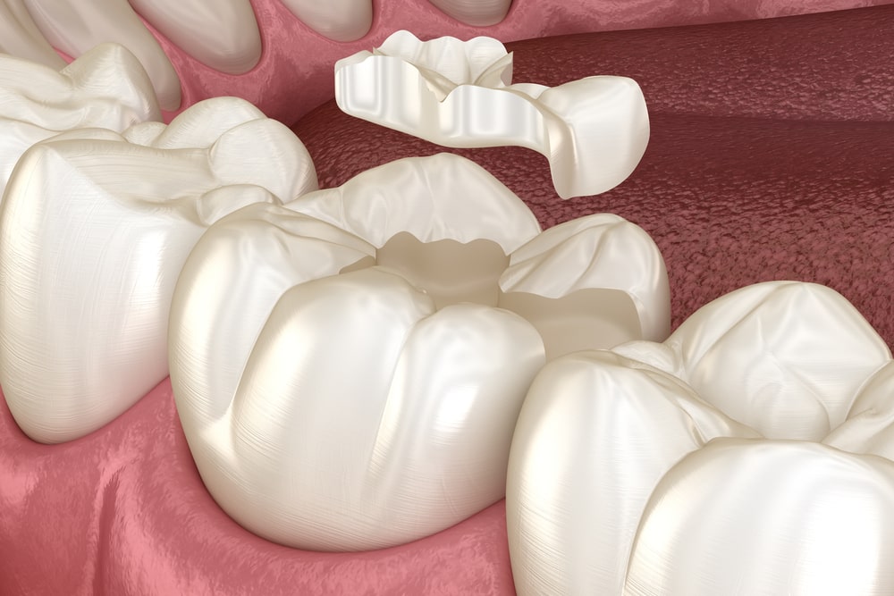 Medically accurate 3D illustration of human teeth treatment