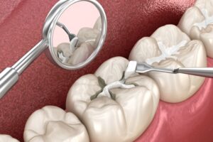 Molar tooth fissure restoration with filling