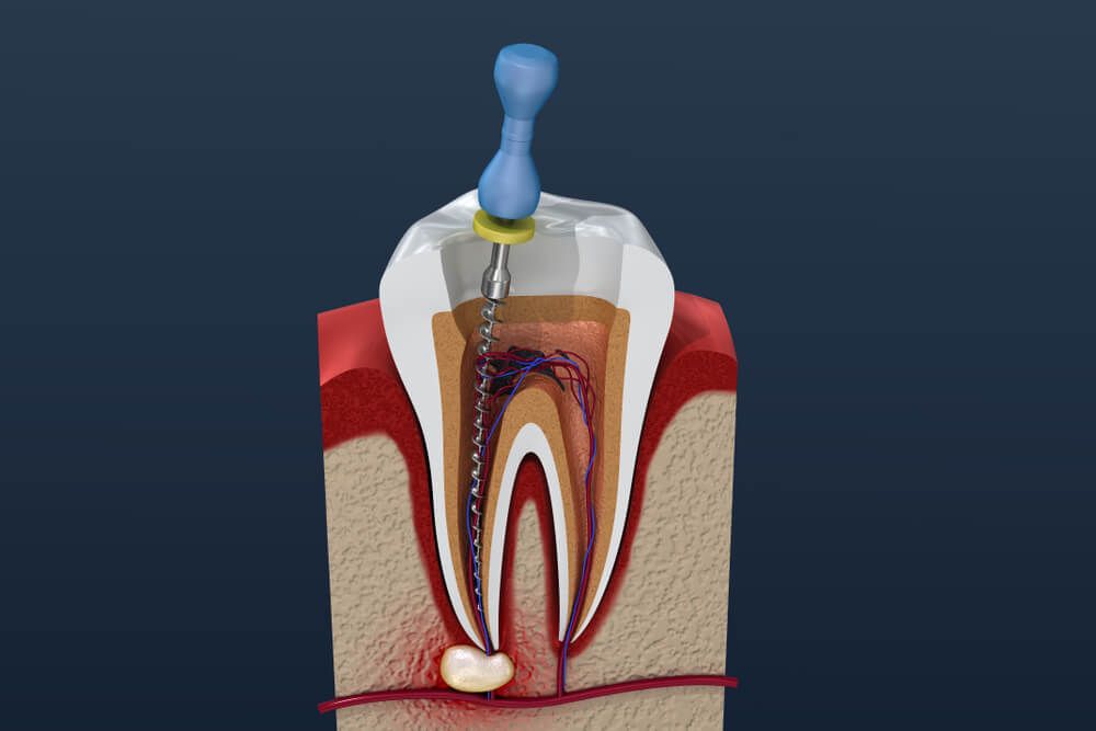 Root canal treatment process
