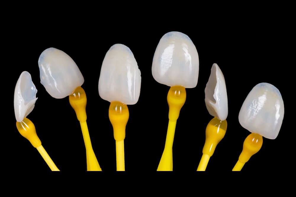 Dental Esthetic Ceramics Laminated Veneers