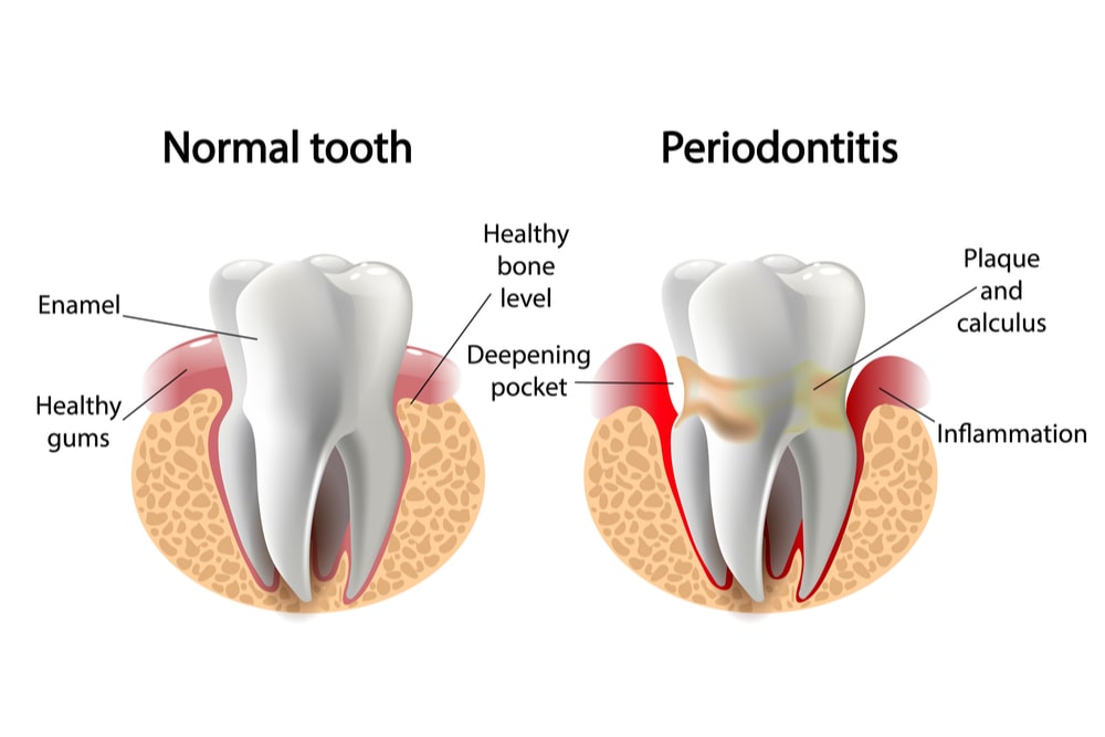 Deep caries Pulpitis Periodontitis.