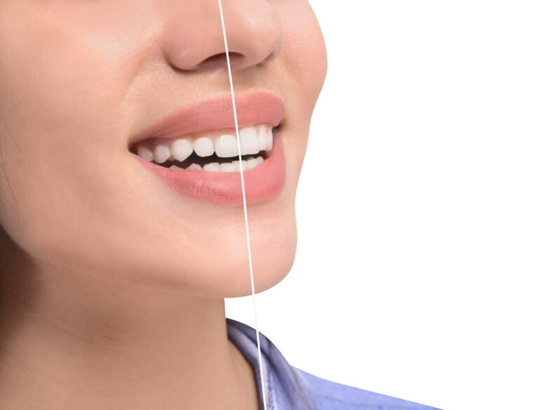 Young woman before and after procedure of gingival plasty on white background, closeup