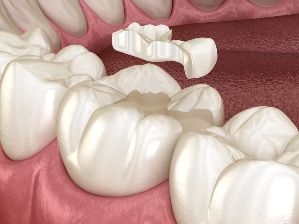Inlay Ceramic Crown Fixation Over Tooth. Medically Accurate 3d Illustration