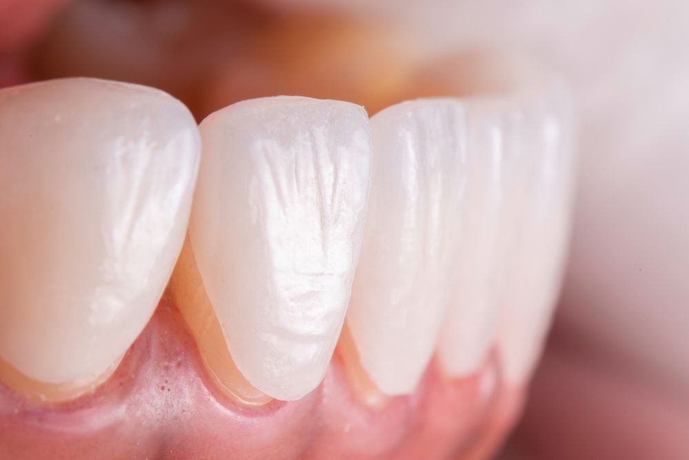 Try In Procedure Of Dental Ceramic Veneers For Lower Teeth