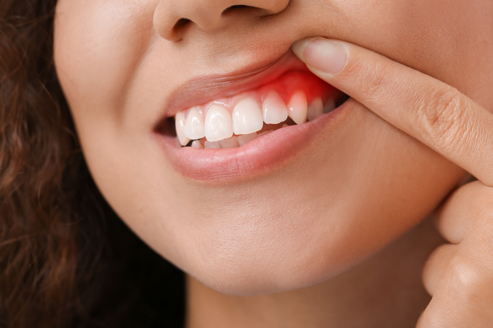 Woman With Gum Inflammation Closeup