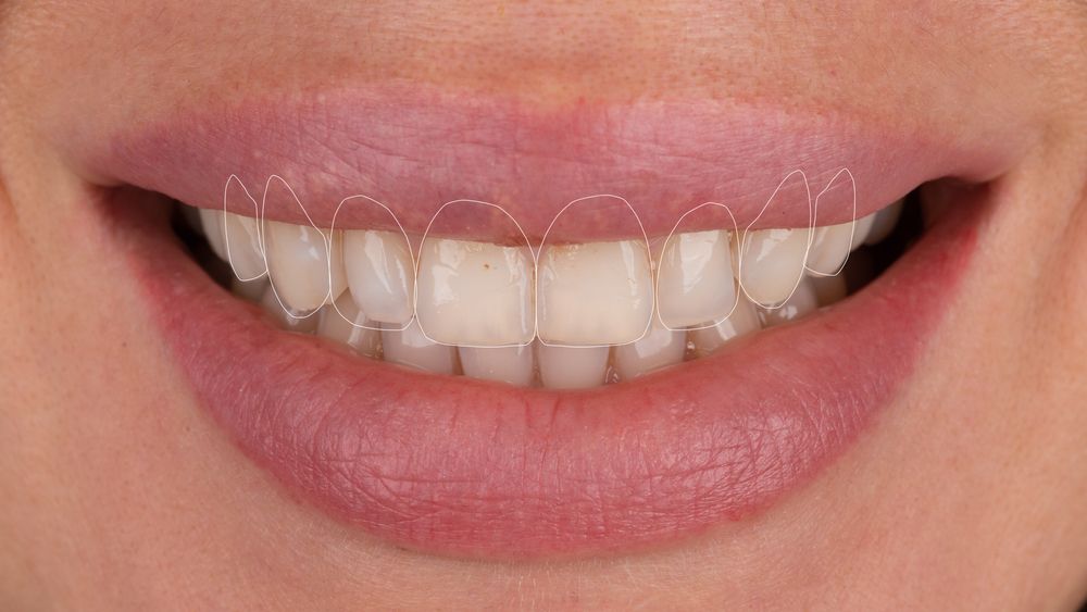 Smile Makeover Plan For Explaining To Patient Before The,Dental