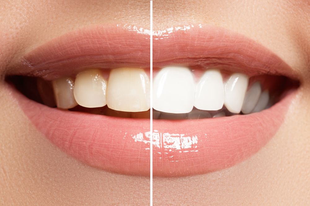 Perfect Smile Before And After Bleaching. Dental Care And Whitening