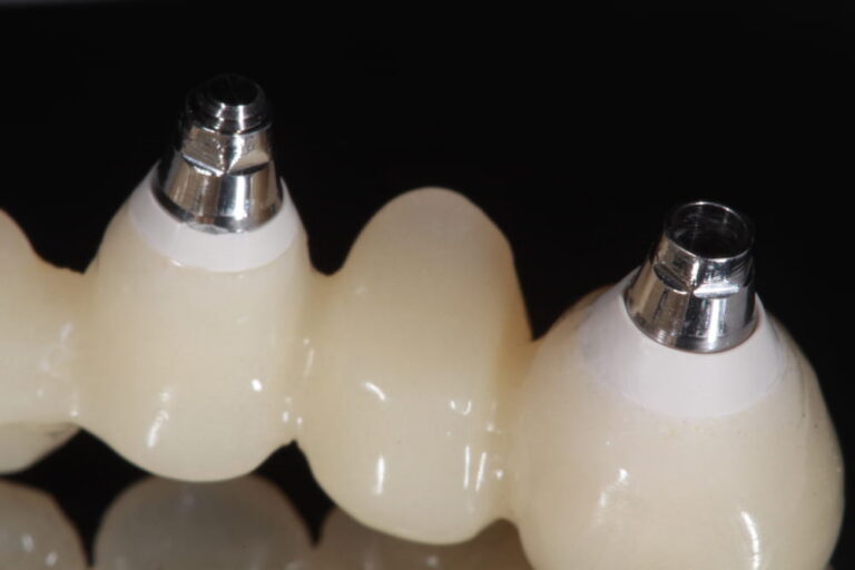 The base of a segment of dental implant bridge, a fix dental prosthesis. Titanium base with porcelain veneer